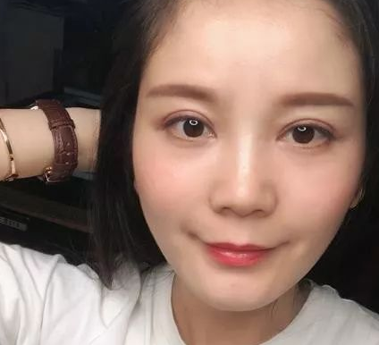 自体脂肪填充术