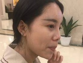 隆鼻手术