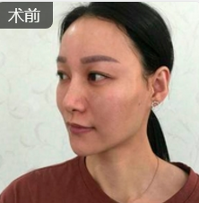 面部提升术