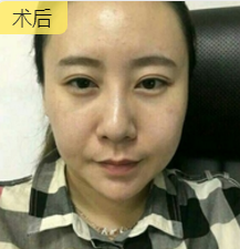 超声波去双下巴