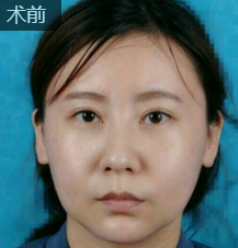 超声波去双下巴