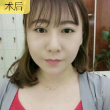 超声波去双下巴