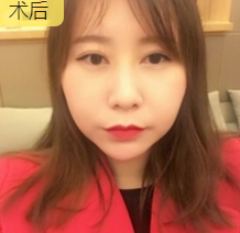 超声波去双下巴