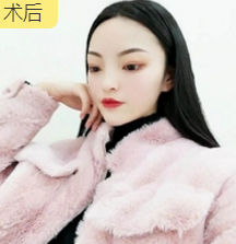 不开刀下巴延长术