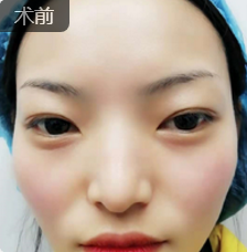 不开刀下巴延长术