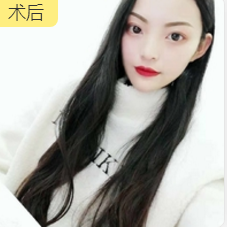 不开刀下巴延长术