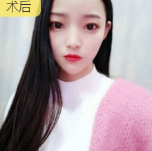 不开刀下巴延长术