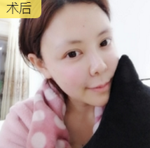 不开刀隆鼻