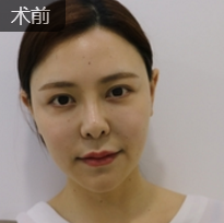 不开刀隆鼻