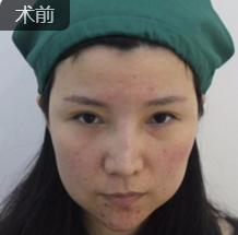 面部提升术