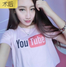 面部提升术