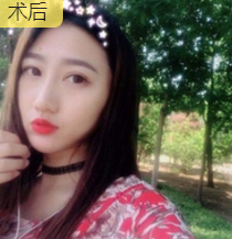 面部提升术