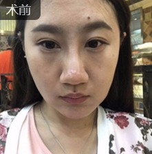 面部提升术