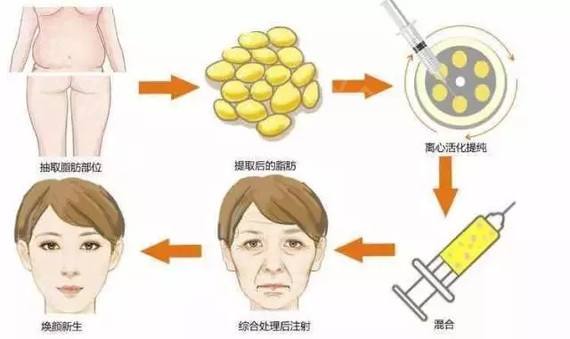 自体脂肪填充术