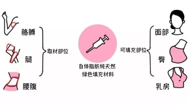 自体脂肪填充术