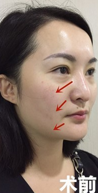 面部提升术
