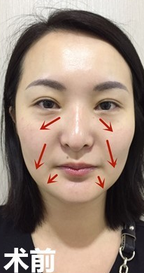 面部提升术
