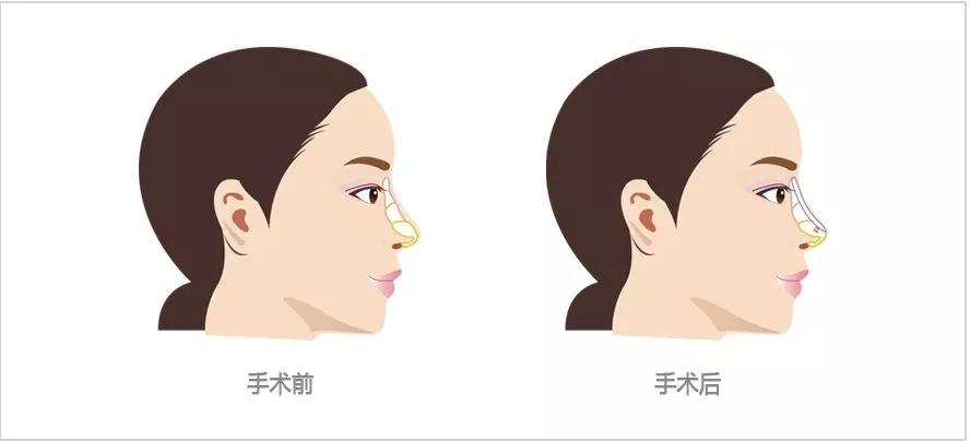 隆鼻手术