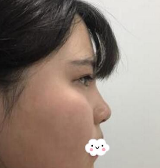 不开刀隆鼻