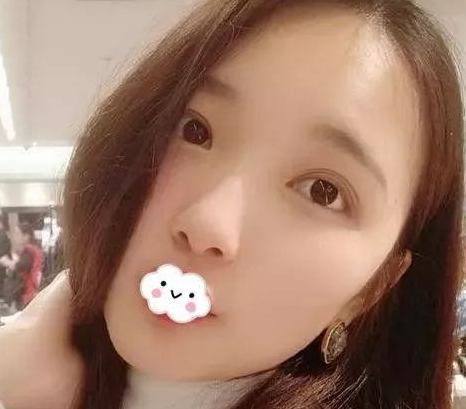 不开刀下巴延长术
