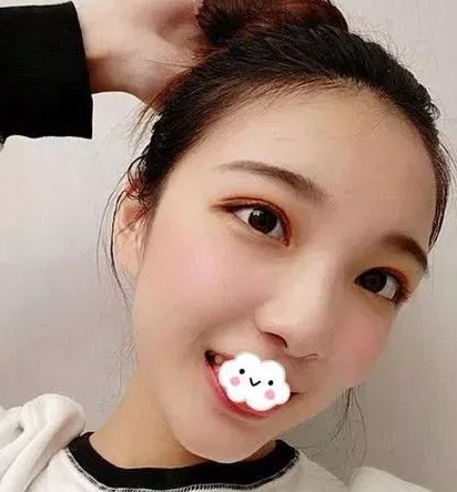 不开刀下巴延长术