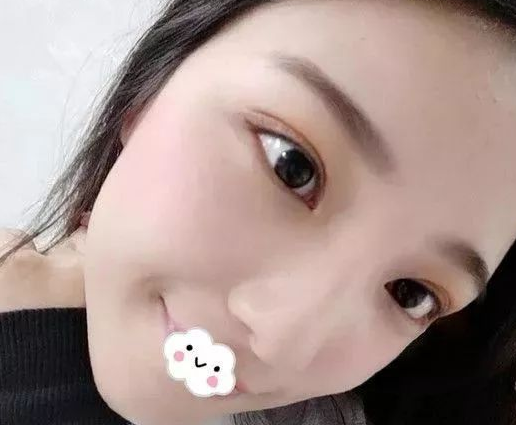 不开刀下巴延长术