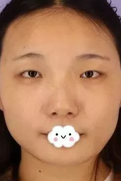 不开刀下巴延长术
