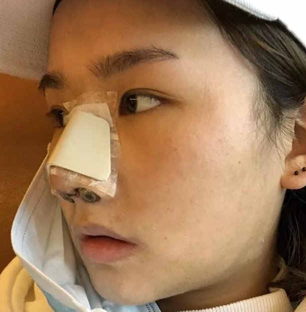 隆鼻手术