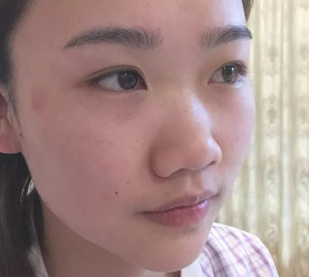 隆鼻手术