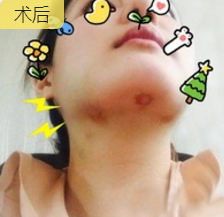 超声波去双下巴