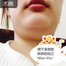 超声波去双下巴
