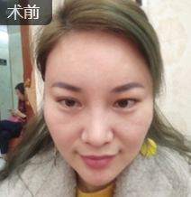 面部提升术