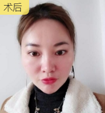 面部提升术