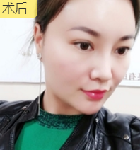 面部提升术