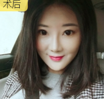 面部提升术