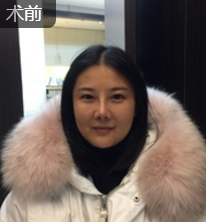 面部提升术