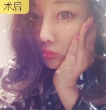 面部提升术