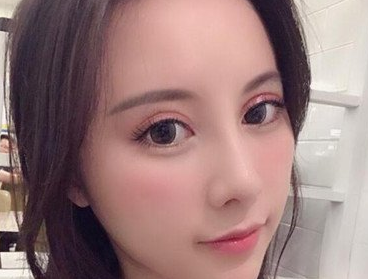 双眼皮手术