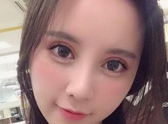 双眼皮手术