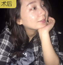 面部提升术