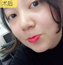 面部提升术