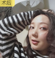 面部提升术
