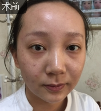 面部提升术