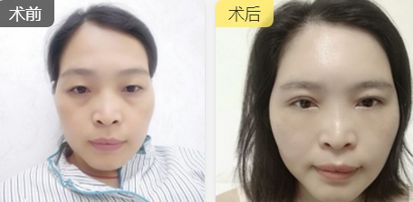 自体脂肪填充术