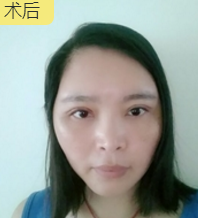 自体脂肪填充术