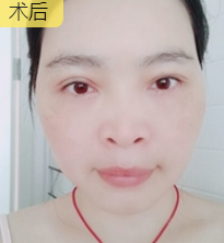 自体脂肪填充术