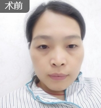 自体脂肪填充术