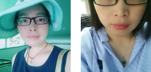 自体脂肪填充术