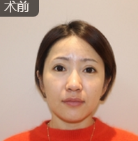 面部提升术