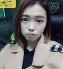 面部提升术